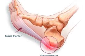 fasceite plantar