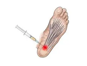 infiltração para tratamento de fasceite plantar