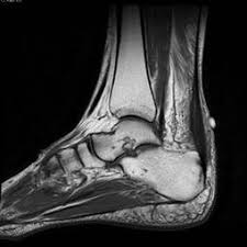 Figura 6: Imagens de ressonância, em corte sagital à esquerda e axial à direita. No corte sagital vemos o espessamento tendíneo e à direita vemos o corpo do aquiles arredondado e espessado.