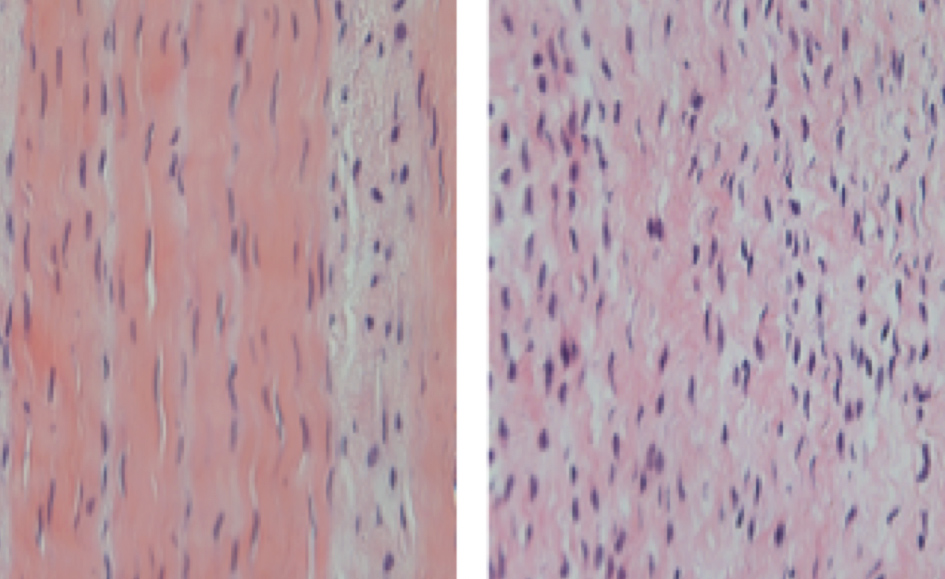 Figura 3: Imagem de microscopia óptica, corada com hematoxacilina e eosina, demonstrando aumento da celularidade do tecido a direita, característica da tendinopatia.