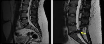 ressonacia magnetica evidenciando  hernia de disco no exame a direita